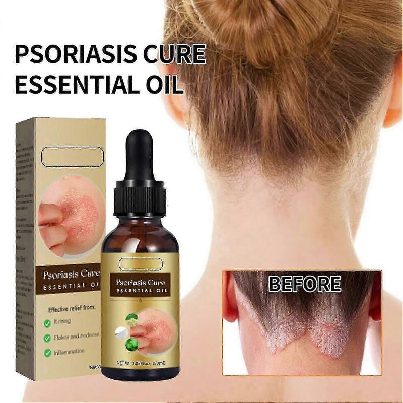 2025 Psoriasis Dandruff Treatment for Scalp, Anti Itching Follicle Booster