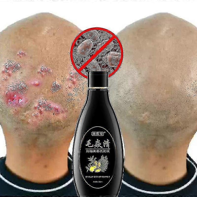 Scalp Hair Follicle Shampoo Antibacterial Anti-itching Mites Oil Control Psoriasis And Scalp Cleansing Shampoo Skincare Product Tw